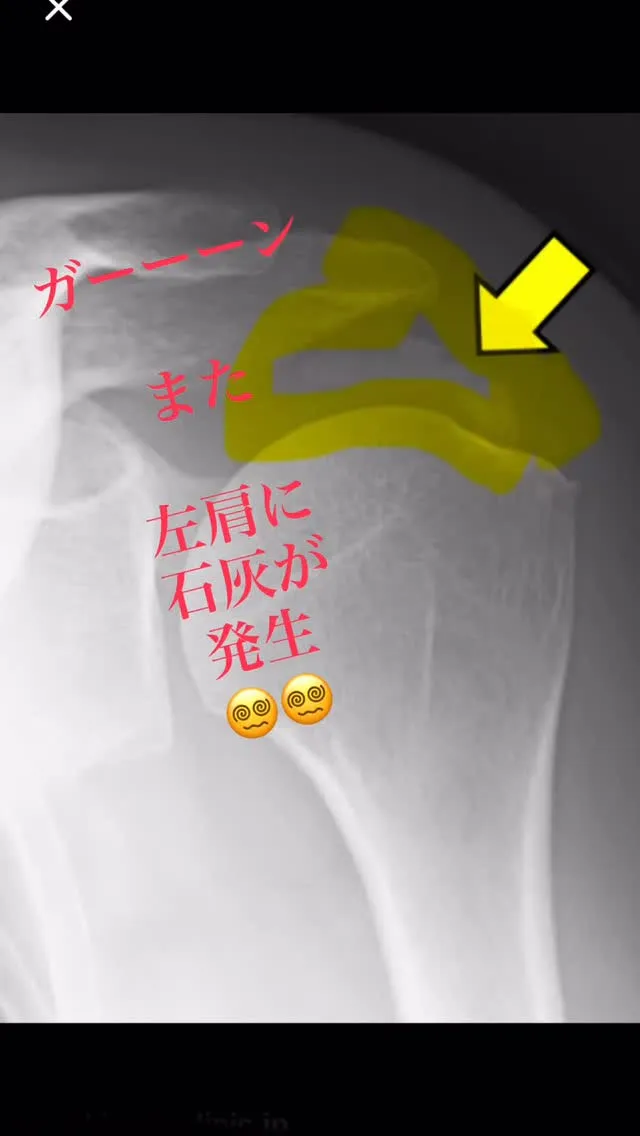 石灰たまりやすい身体なの？